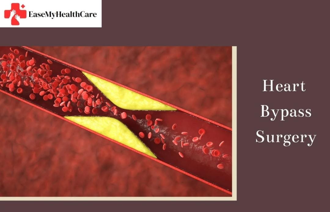 Best Hospital in India for Heart Bypass Surgery