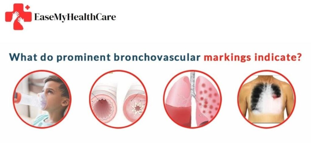 What Are Bronchovascular Markings?
