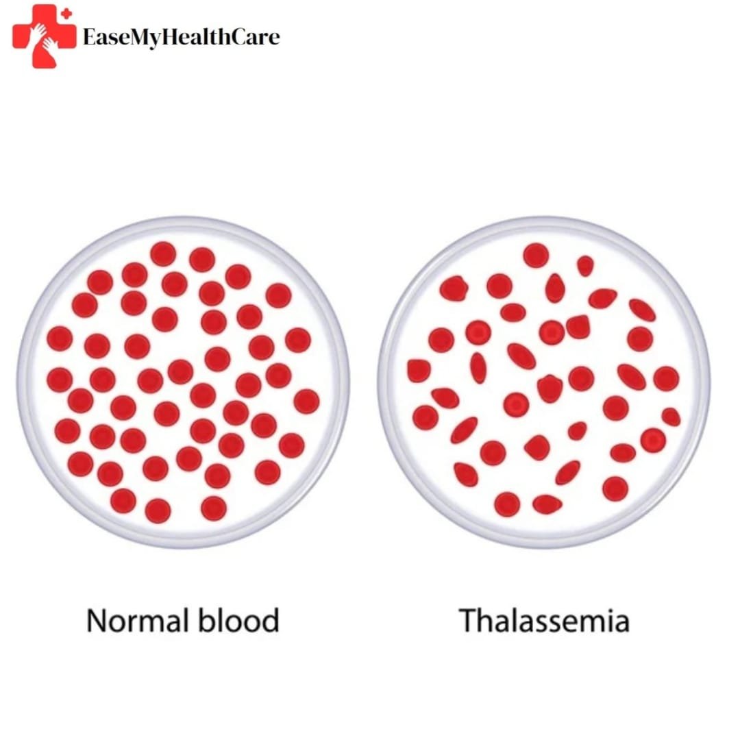 Thalassemia Treatment