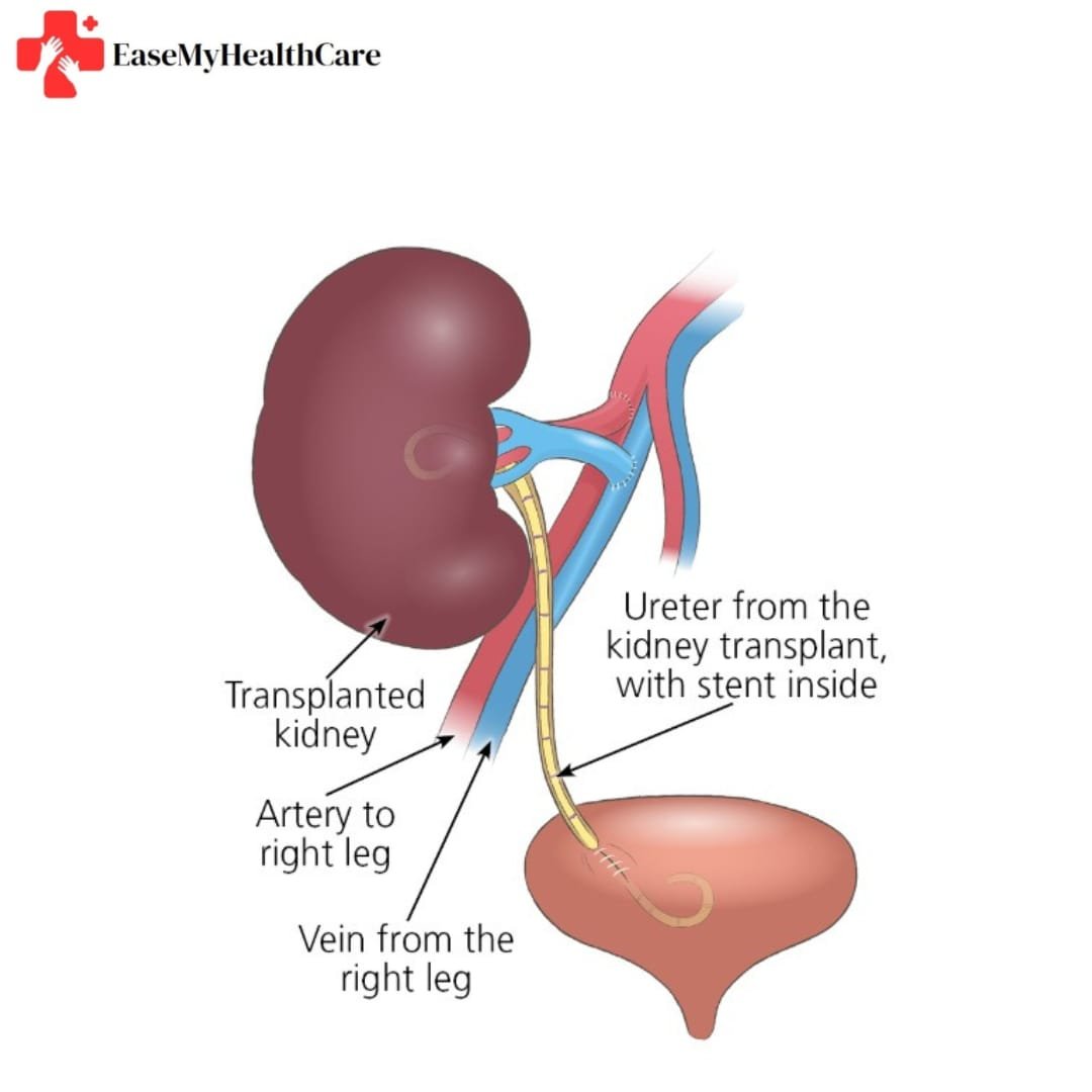 Kidney Transplant