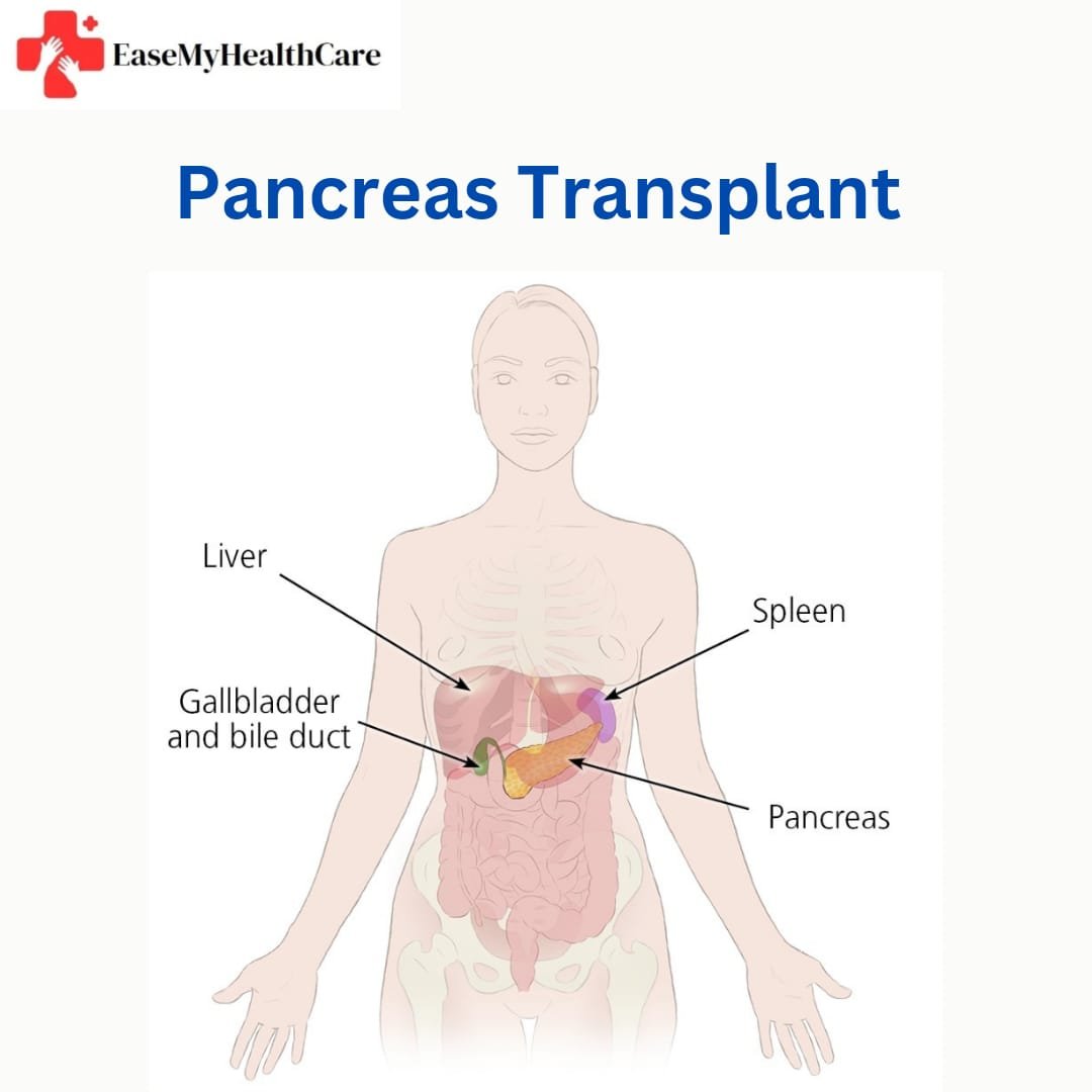 Affordable Pancreas Transplant