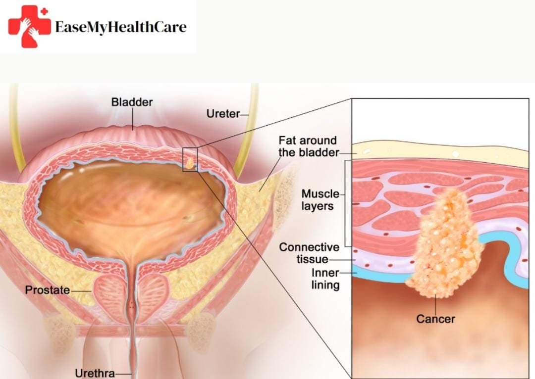 Bladder Cancer Treatment