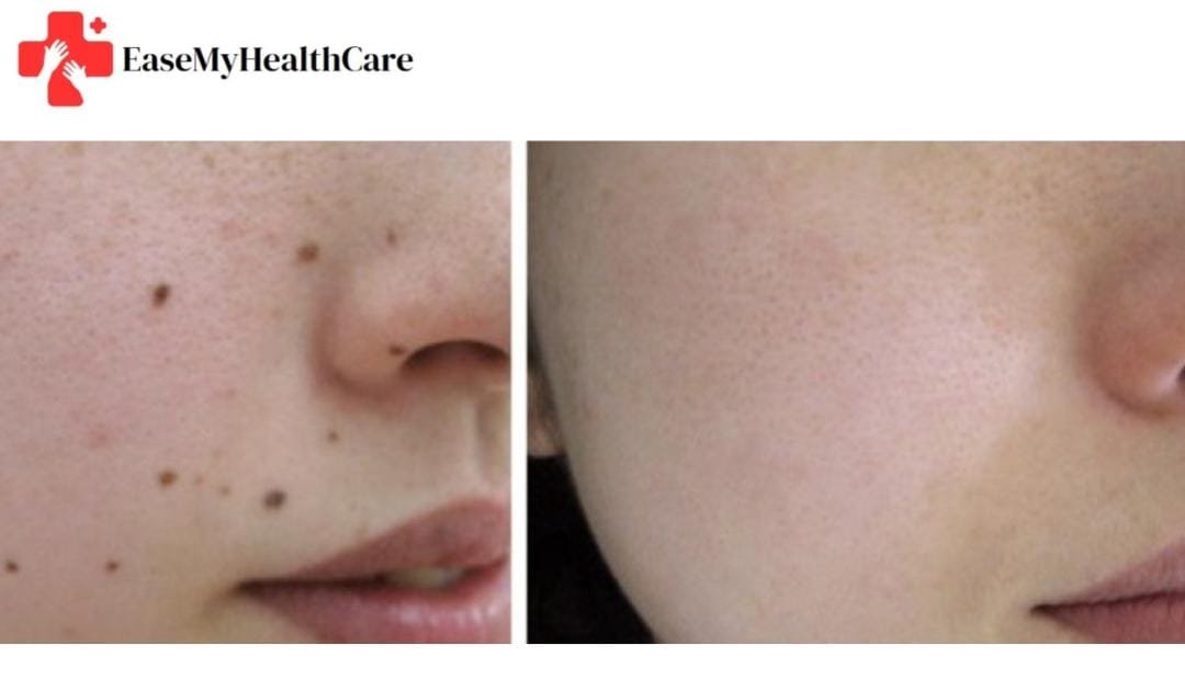 Laser Mole Removal Cost in India