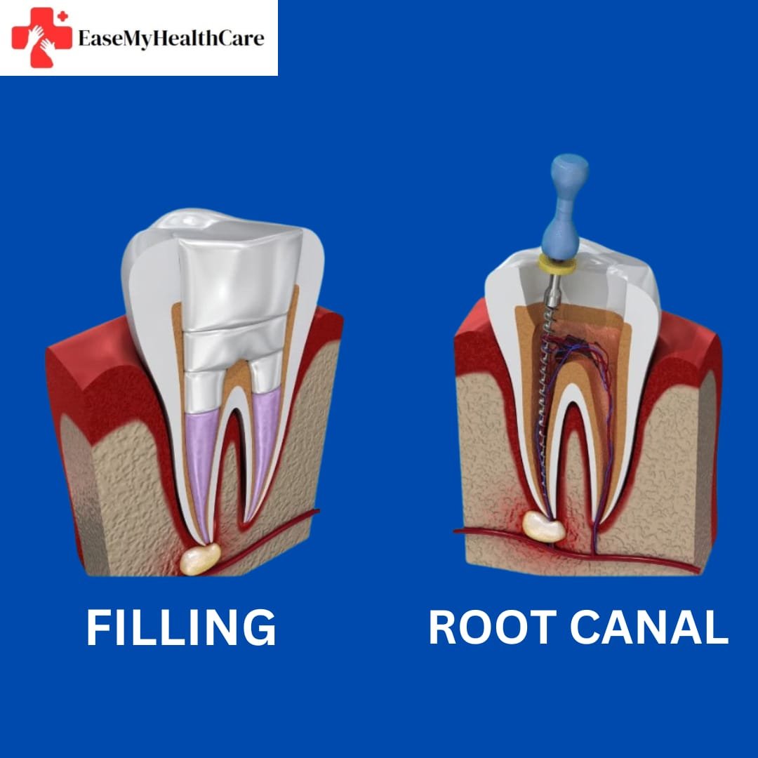 Root Canal Cost in India