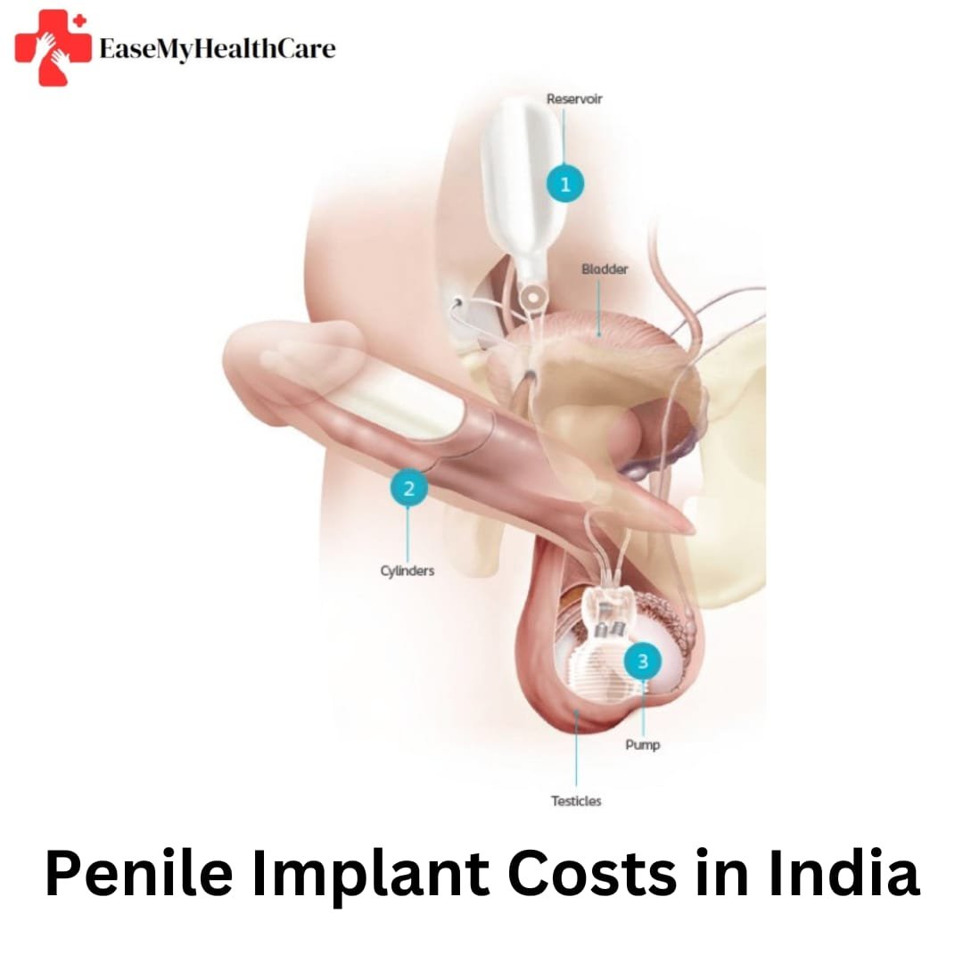 Penile Implant Costs in India