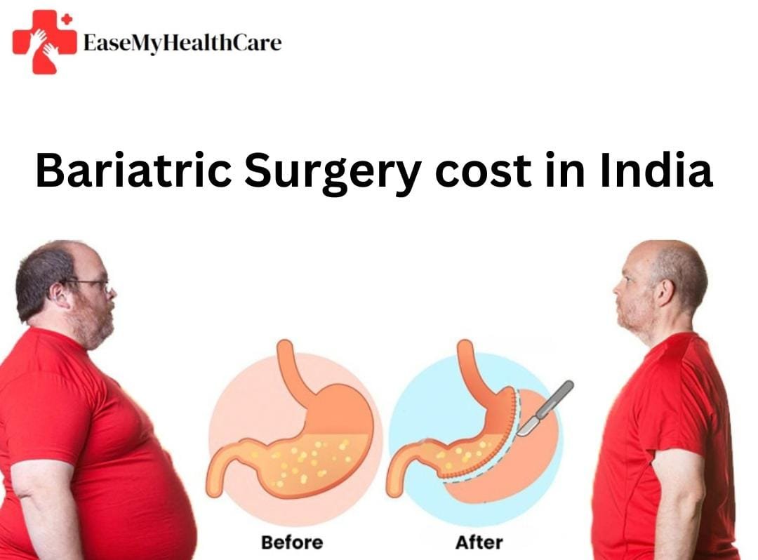 Bariatric Surgery Cost in India