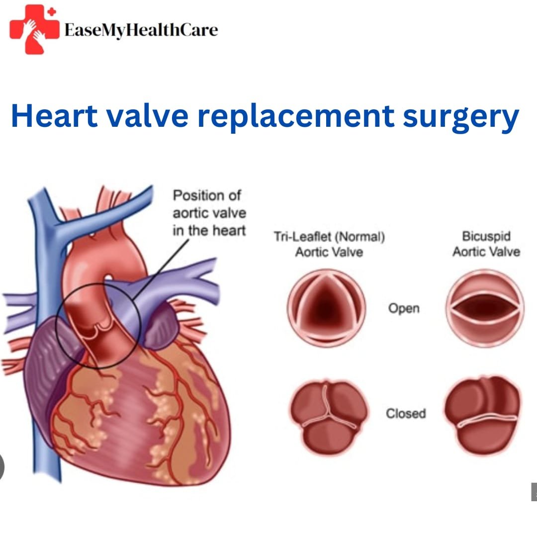 Valve Replacement Surgery