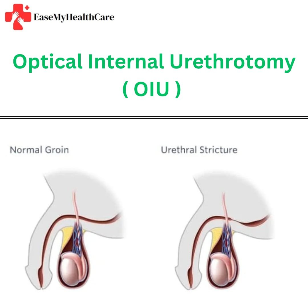 Optical Internal Urethrotomy (OIU)