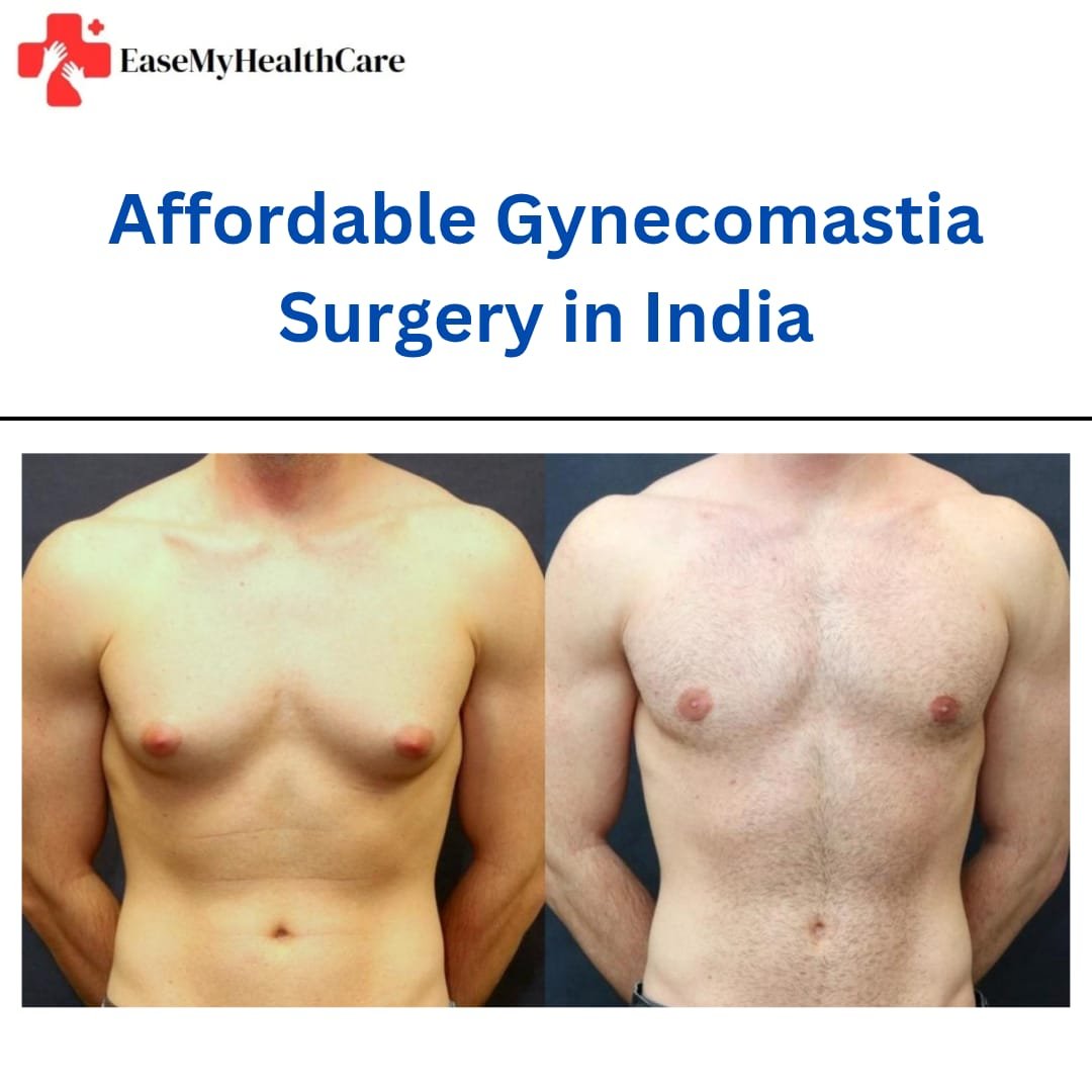 Affordable Gynecomastia Surgery in India