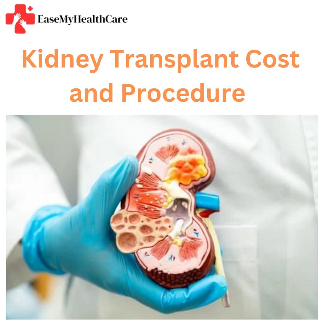 Kidney Transplant Cost in Government and Private Hospitals
