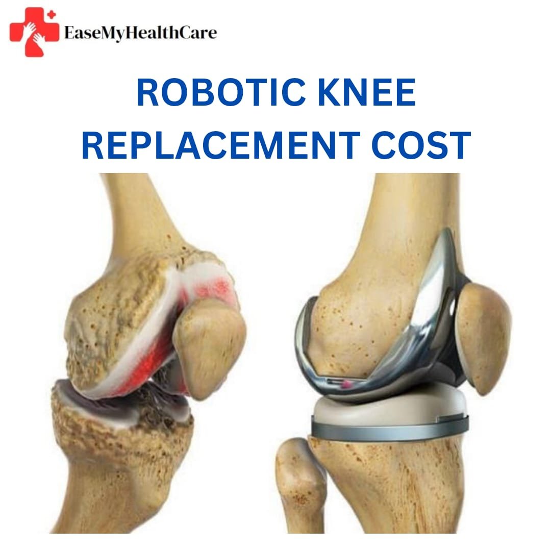 Robotic Knee Replacement Cost