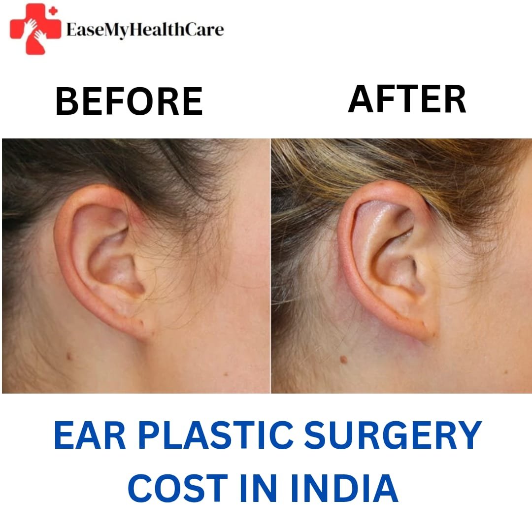 Ear Plastic Surgery Cost in India