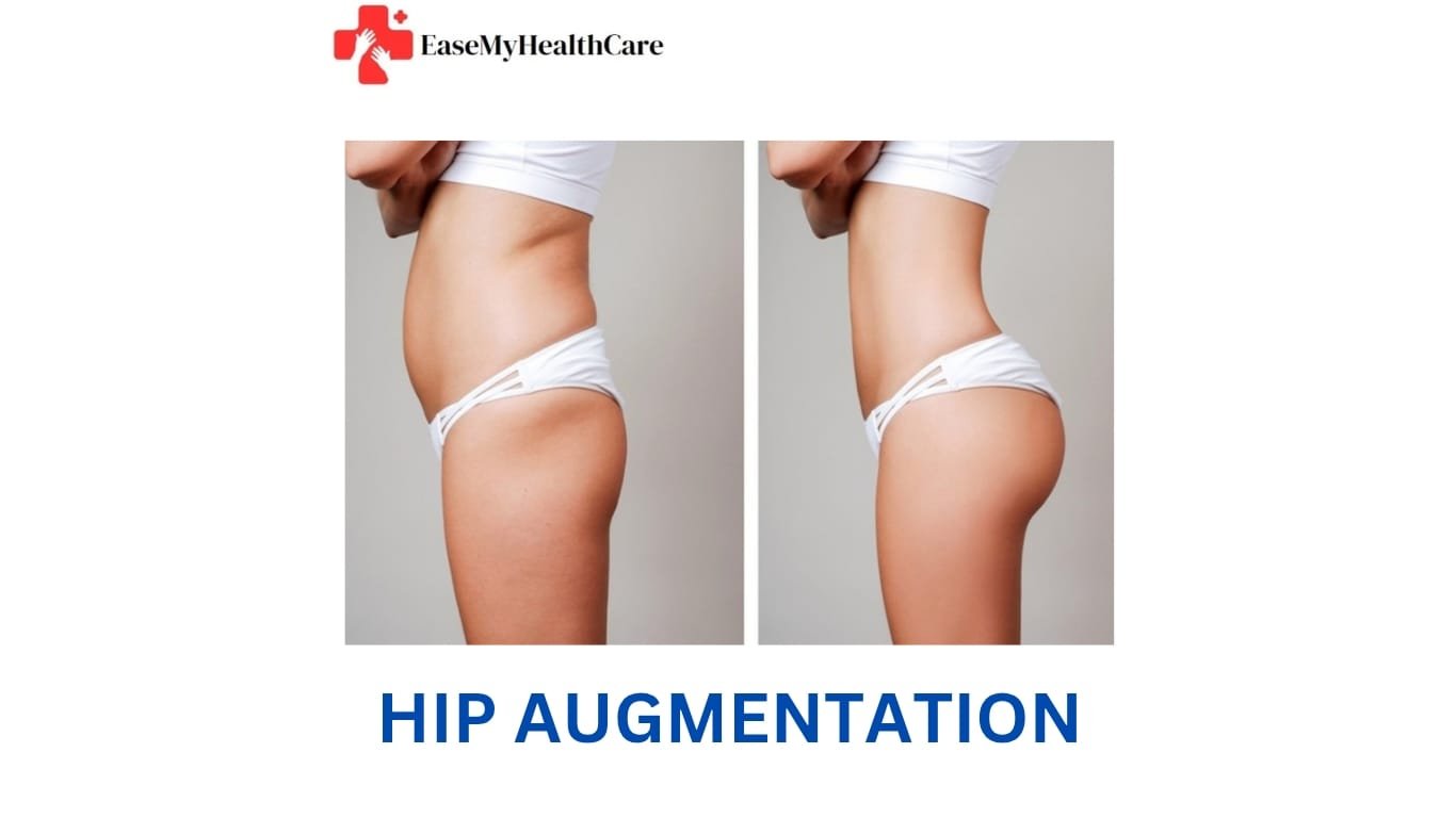 Hip Augmentation Cost in India – Procedure, Benefits & Best Hospitals
