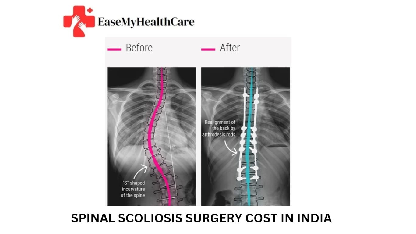 Scoliosis Surgery Cost in India