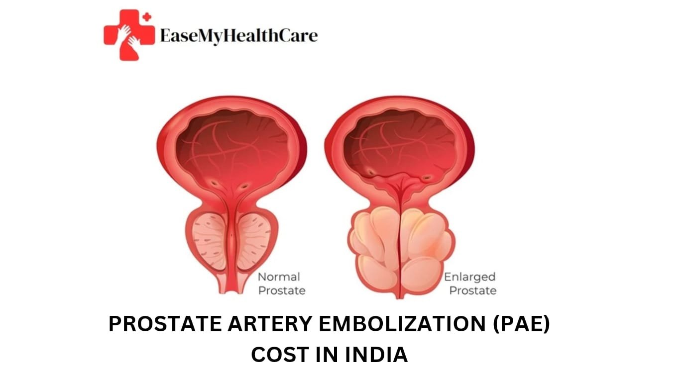 Prostate Artery Embolization (PAE) Cost in India