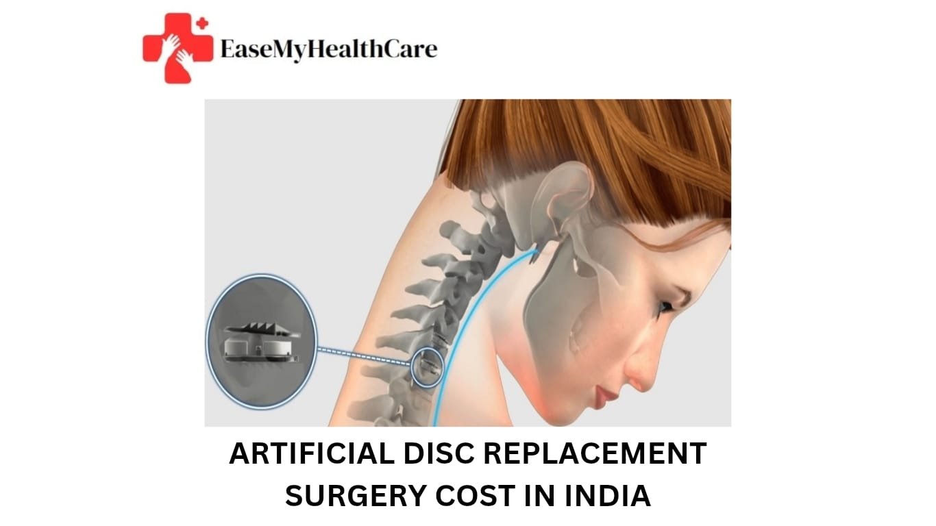 Artificial Disc Replacement Surgery Cost in India