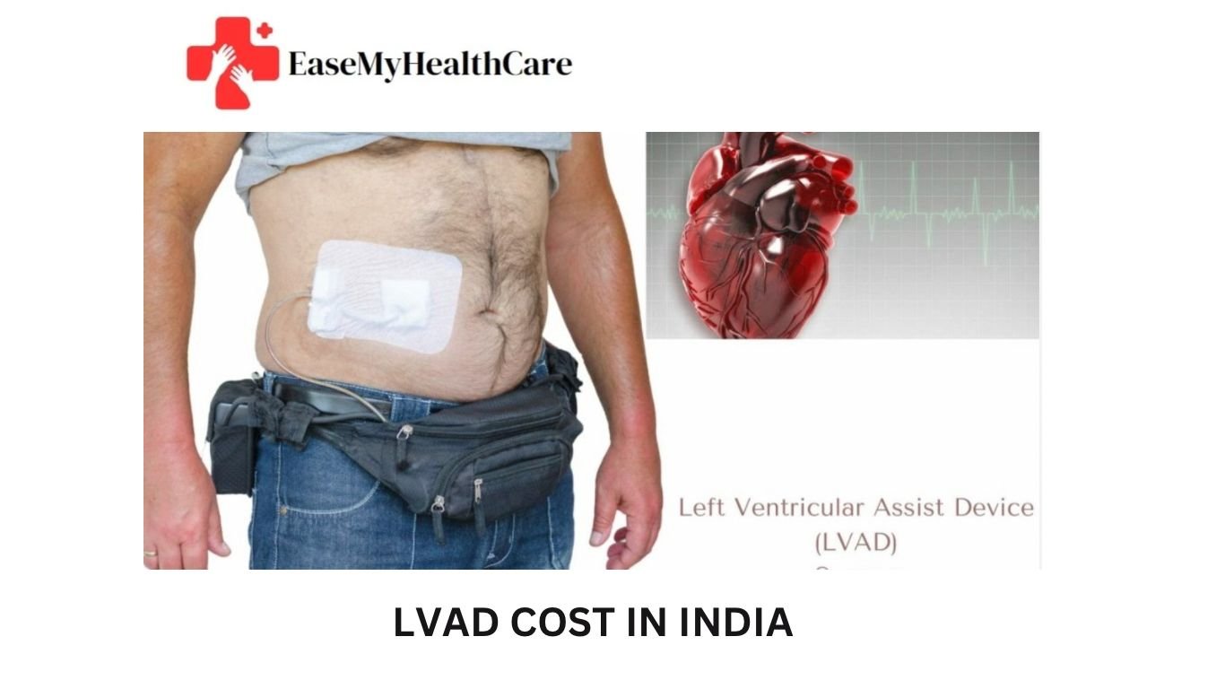 LVAD Cost in India: Advanced Cardiac Care