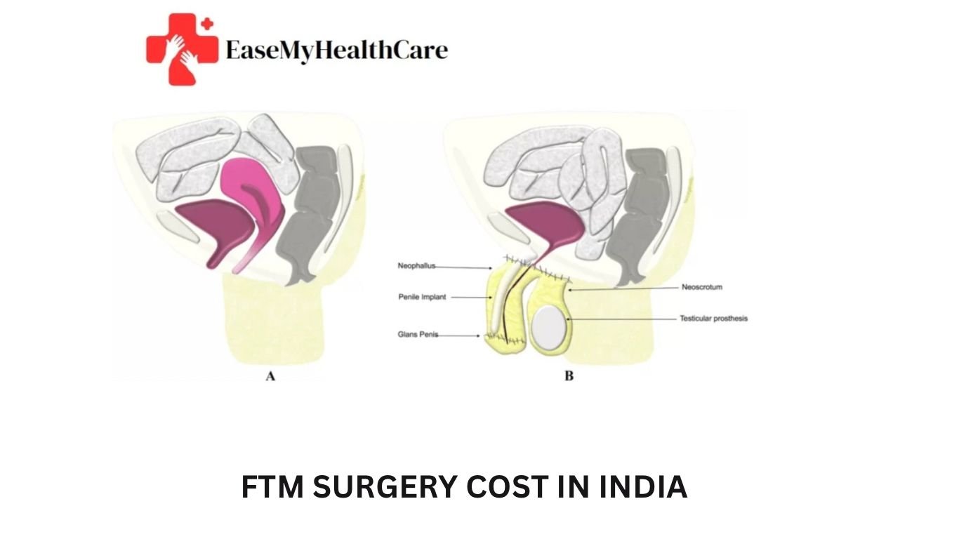 A Comprehensive Guide to FTM Surgery Cost in India for International Patients