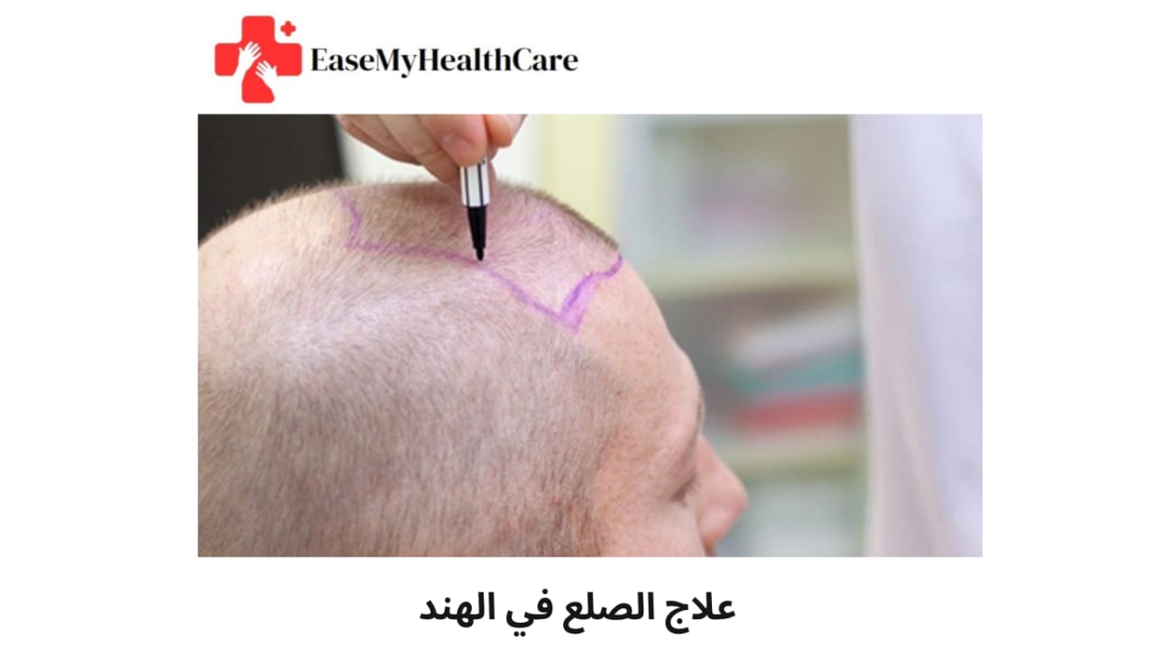 علاج الصلع في الهند