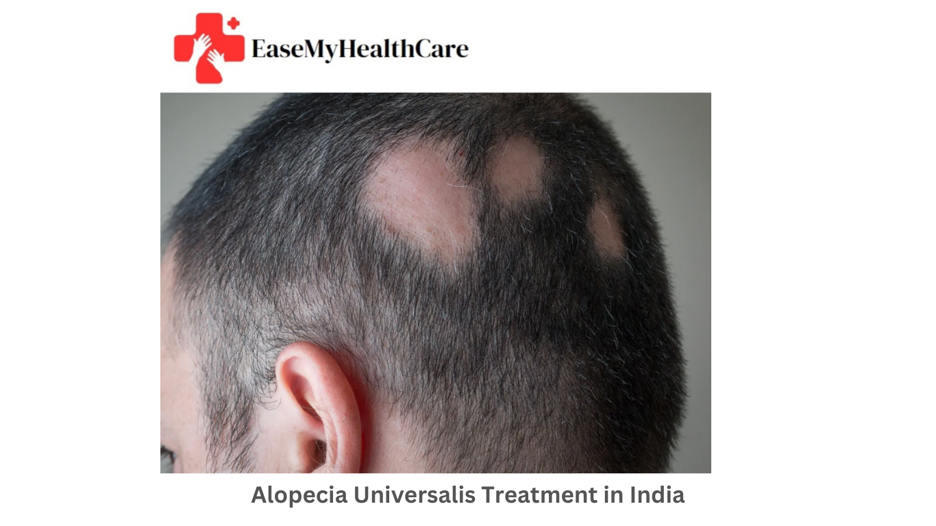 Alopecia Universalis Treatment