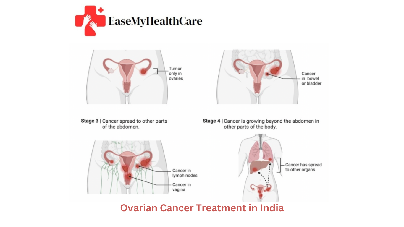 Ovarian Cancer Treatment in India