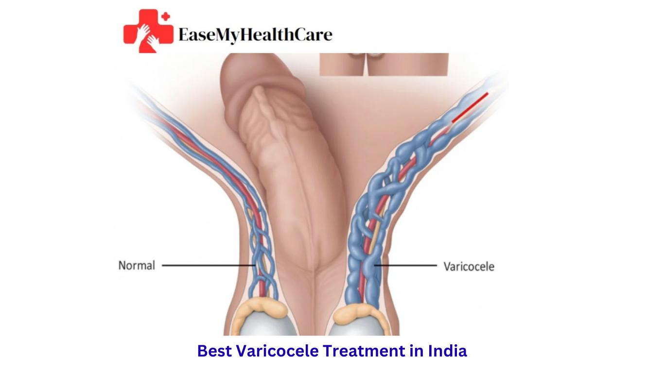 Best Varicocele Treatment in India