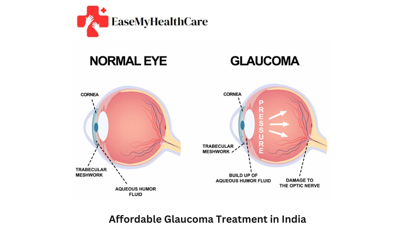 GLAUCOMA TREATMENT IN INDIA
