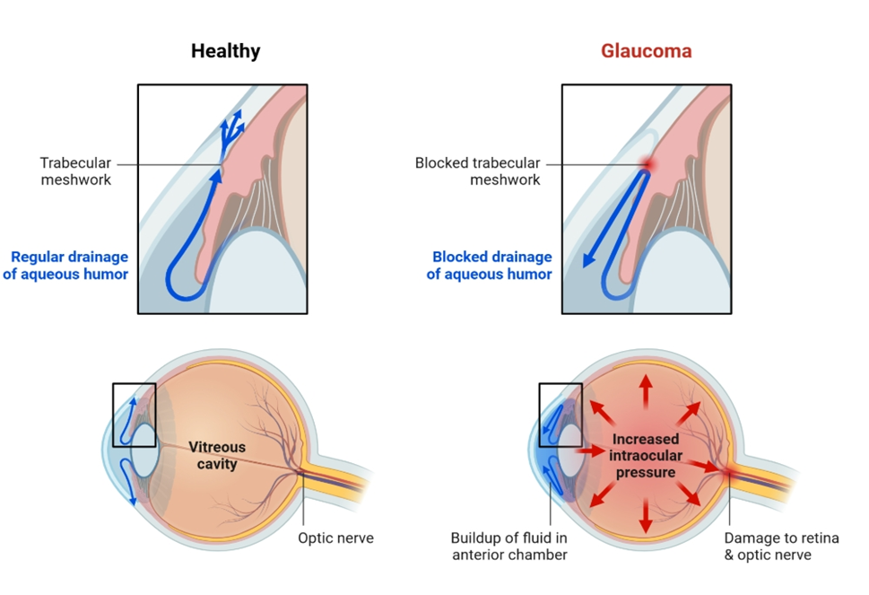 Glaucoma Treatment in India