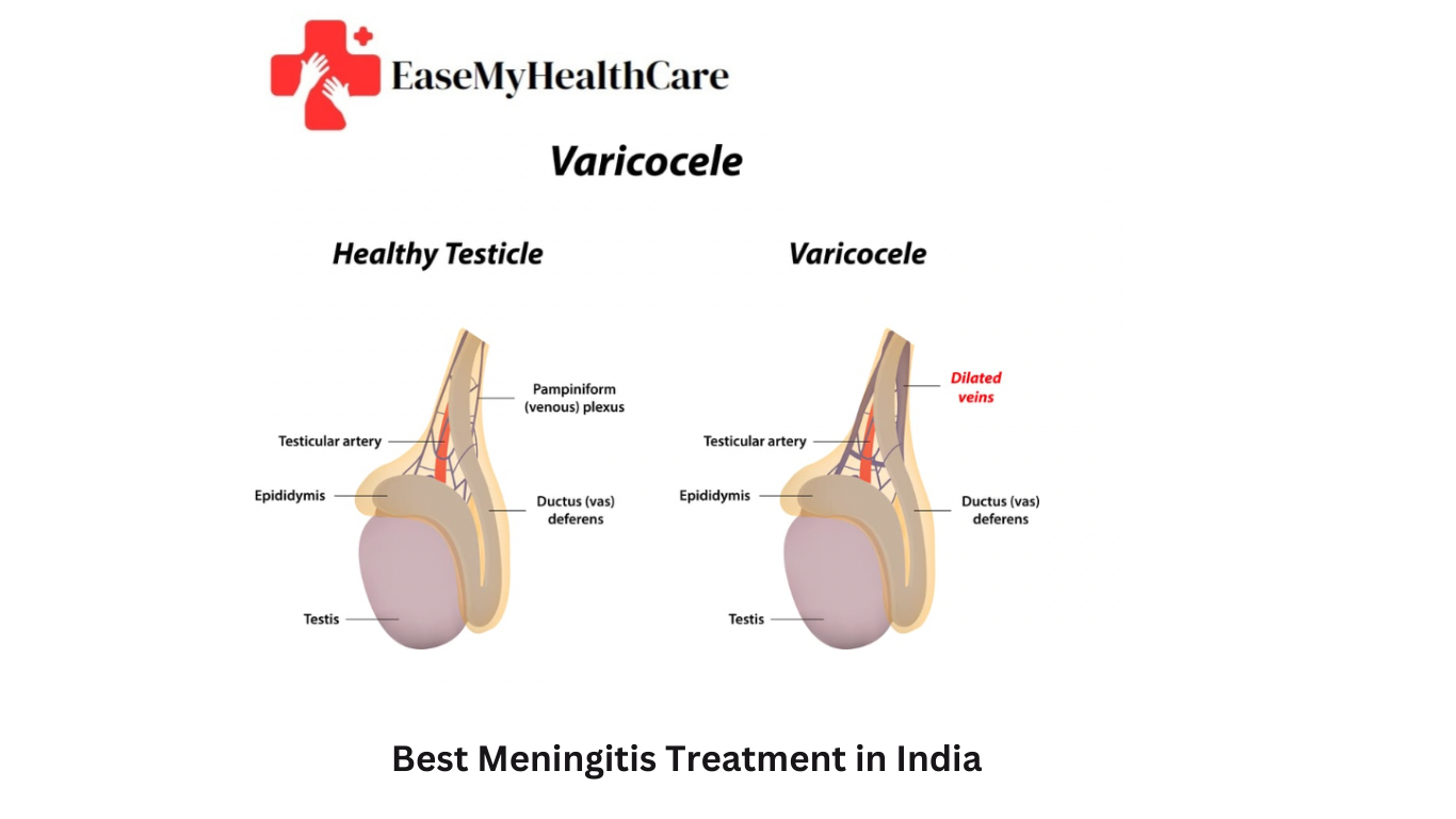 Best Varicocele Treatment in India