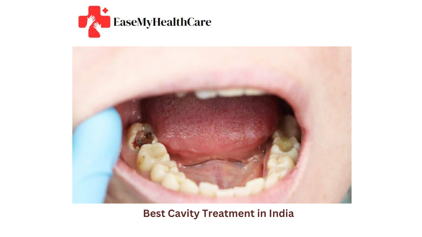 Cavity Treatment Cost in India