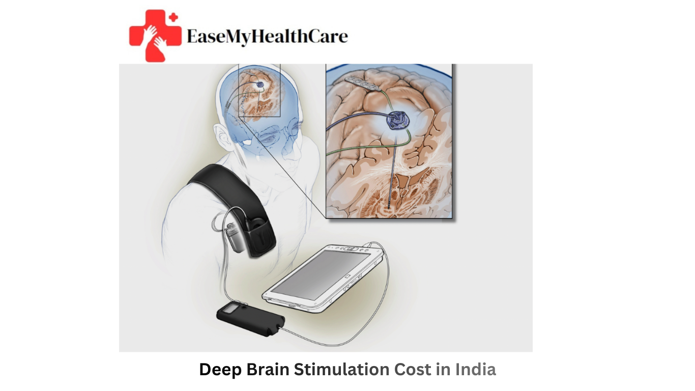 Deep Brain Stimulation Cost in India (DBS)