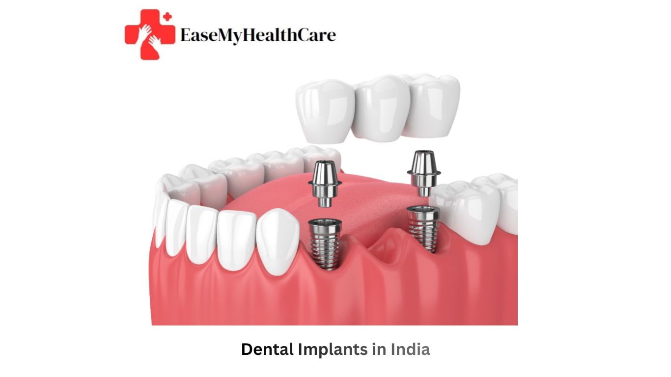 Dental Implant Clinics in India
