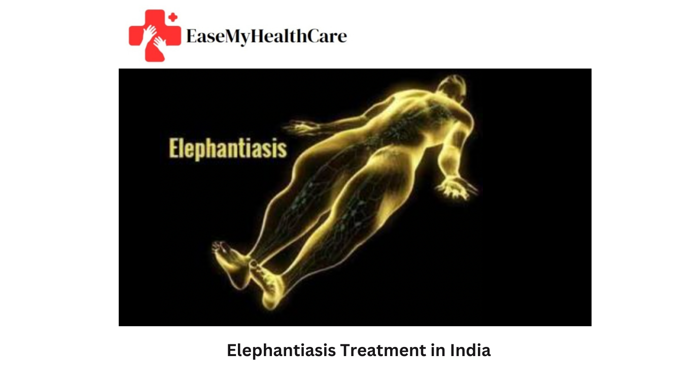 Elephantiasis Treatment in India