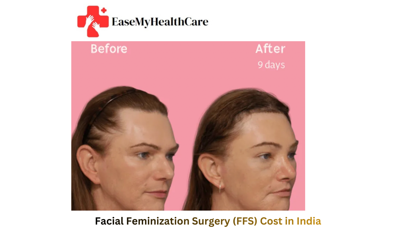 Facial Feminization Surgery (FFS) Cost
