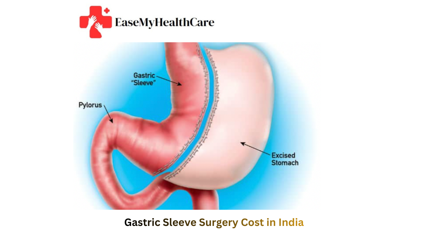 Gastric Sleeve Surgery Cost in India in 2026