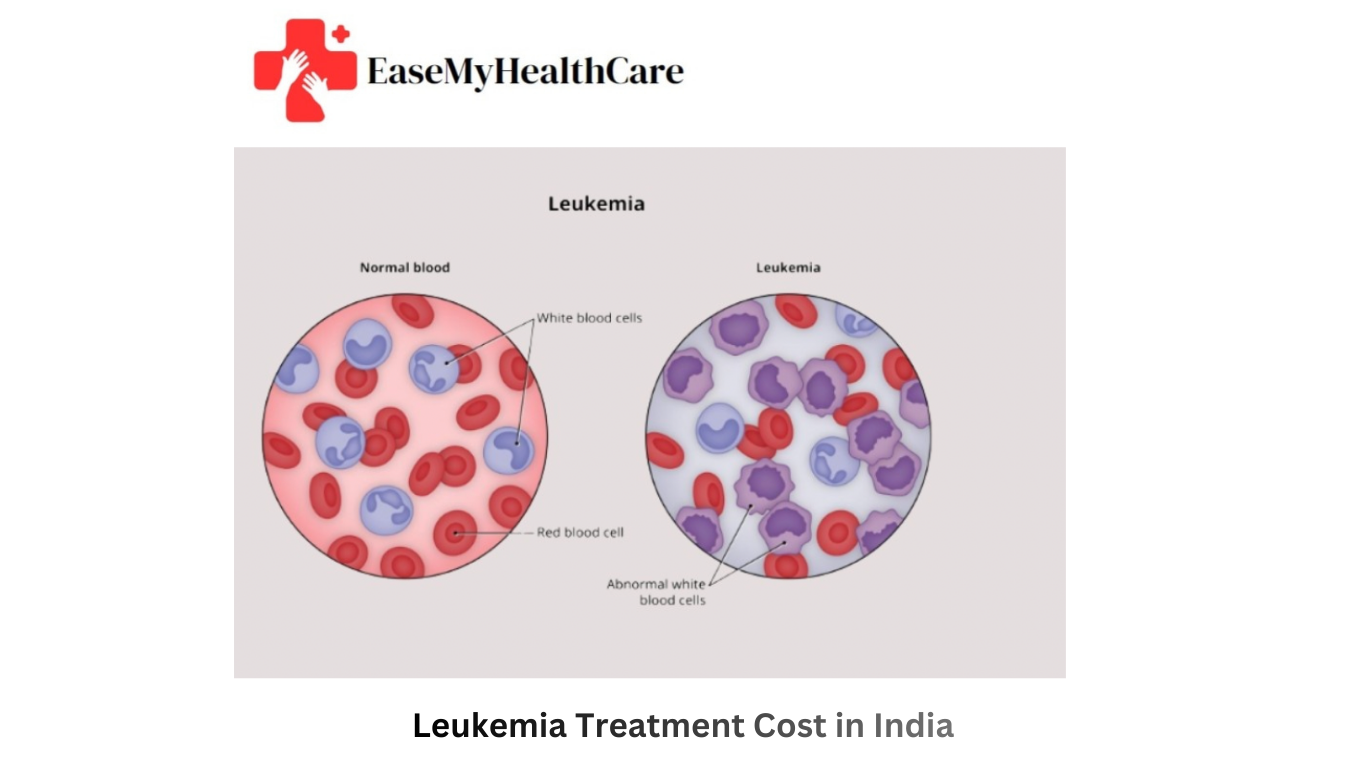Leukemia Treatment Cost in India