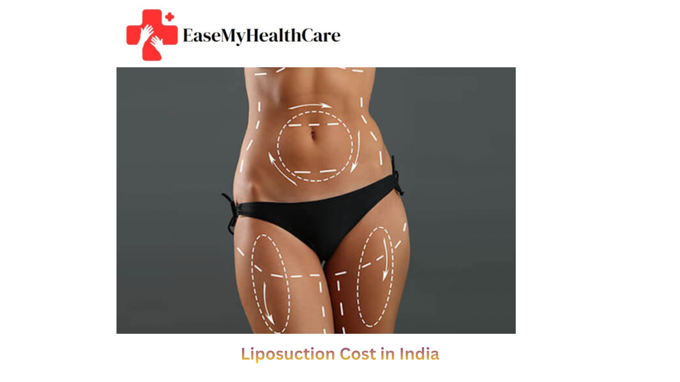 Liposuction in India