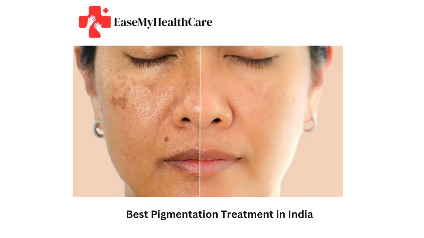 Laser Treatment for Pigmentation Cost in India: Complete Patient Guide