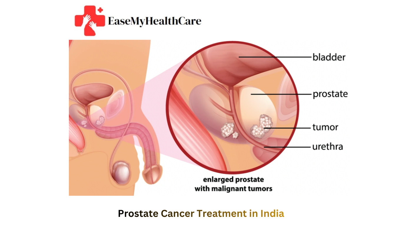 Prostate Cancer Treatment in India