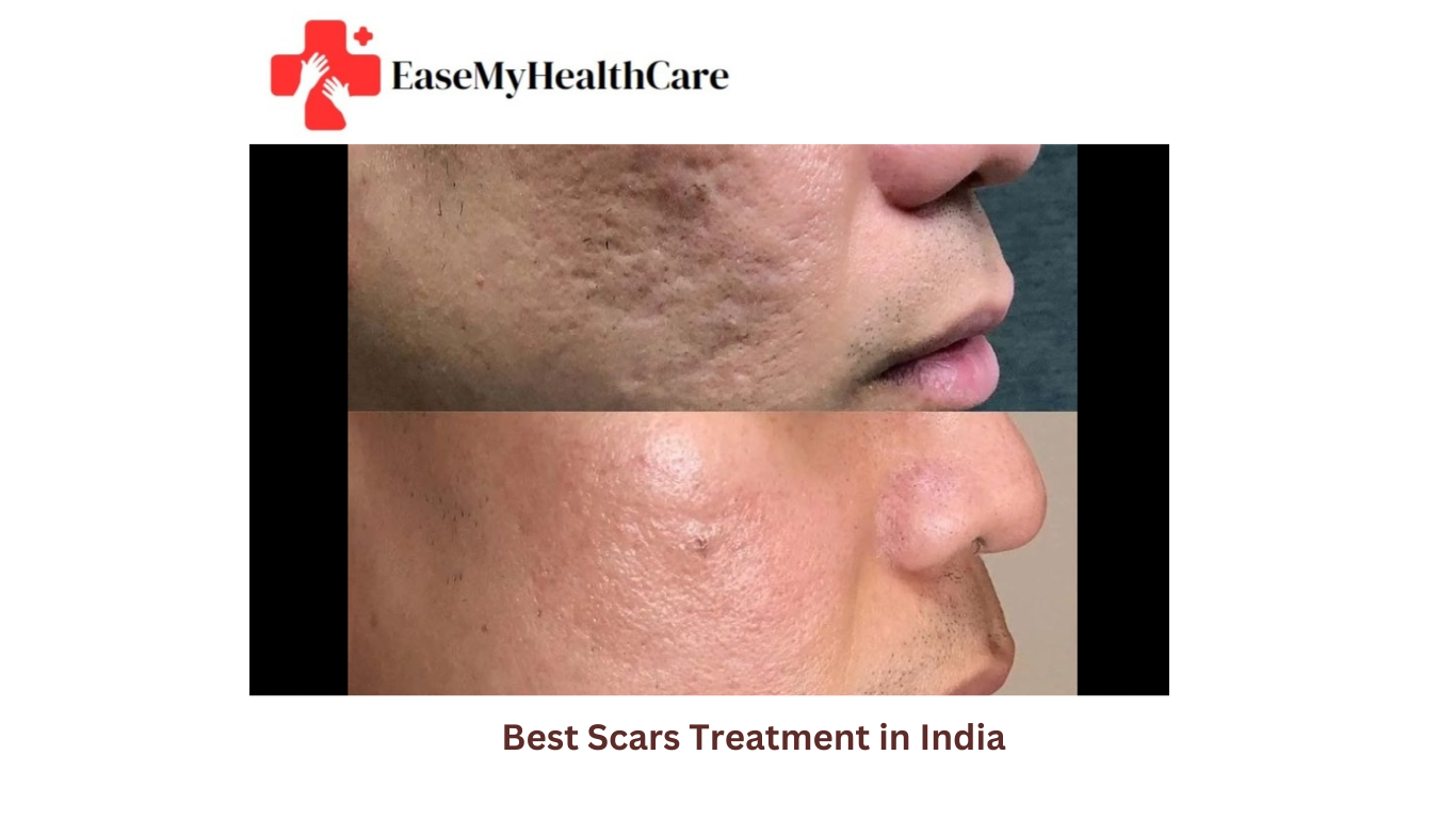 Laser Treatment for Acne Scars Cost in India | Scar Creams & Best Clinics