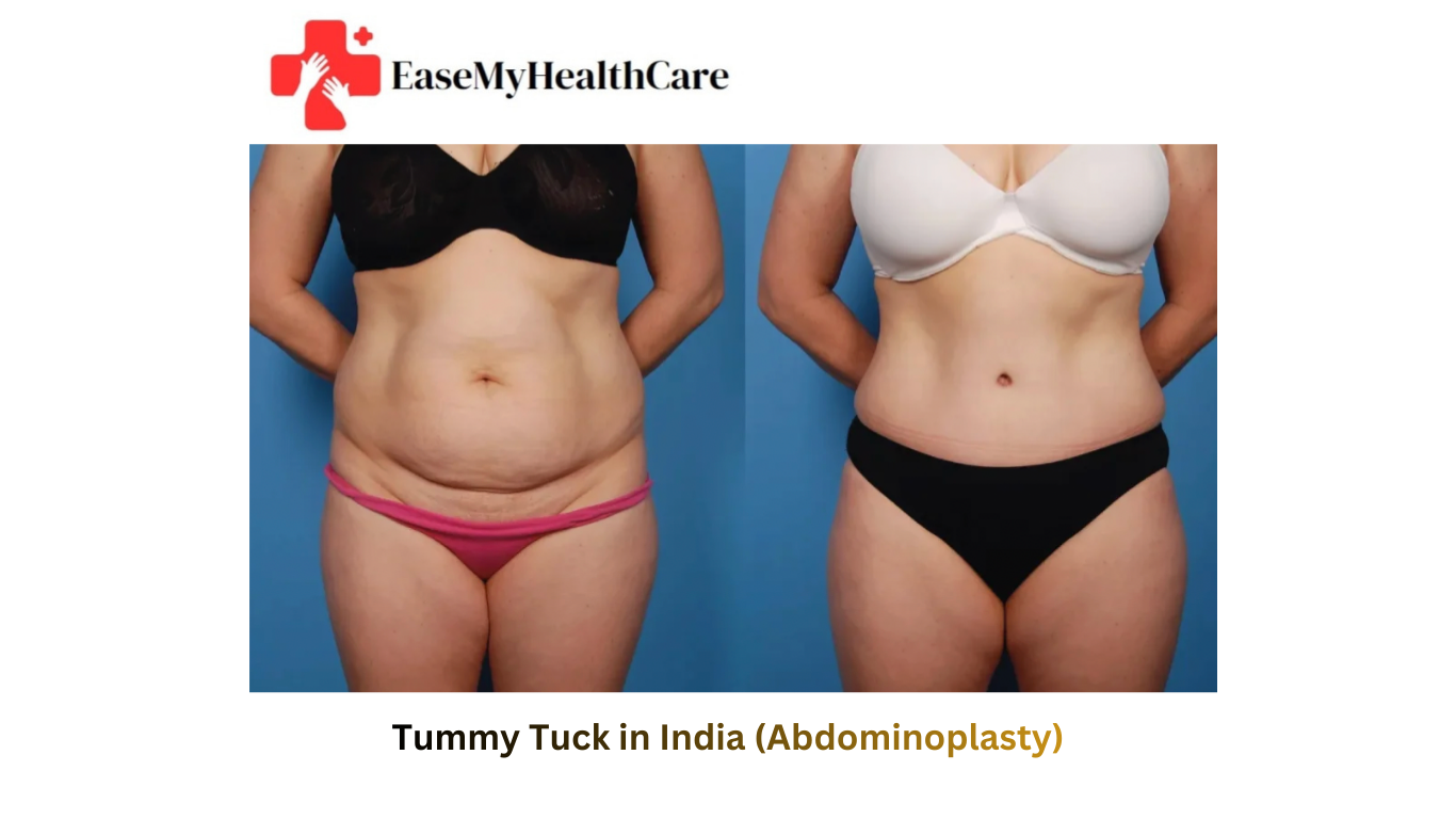 Tummy Tuck in India (Abdominoplasty)