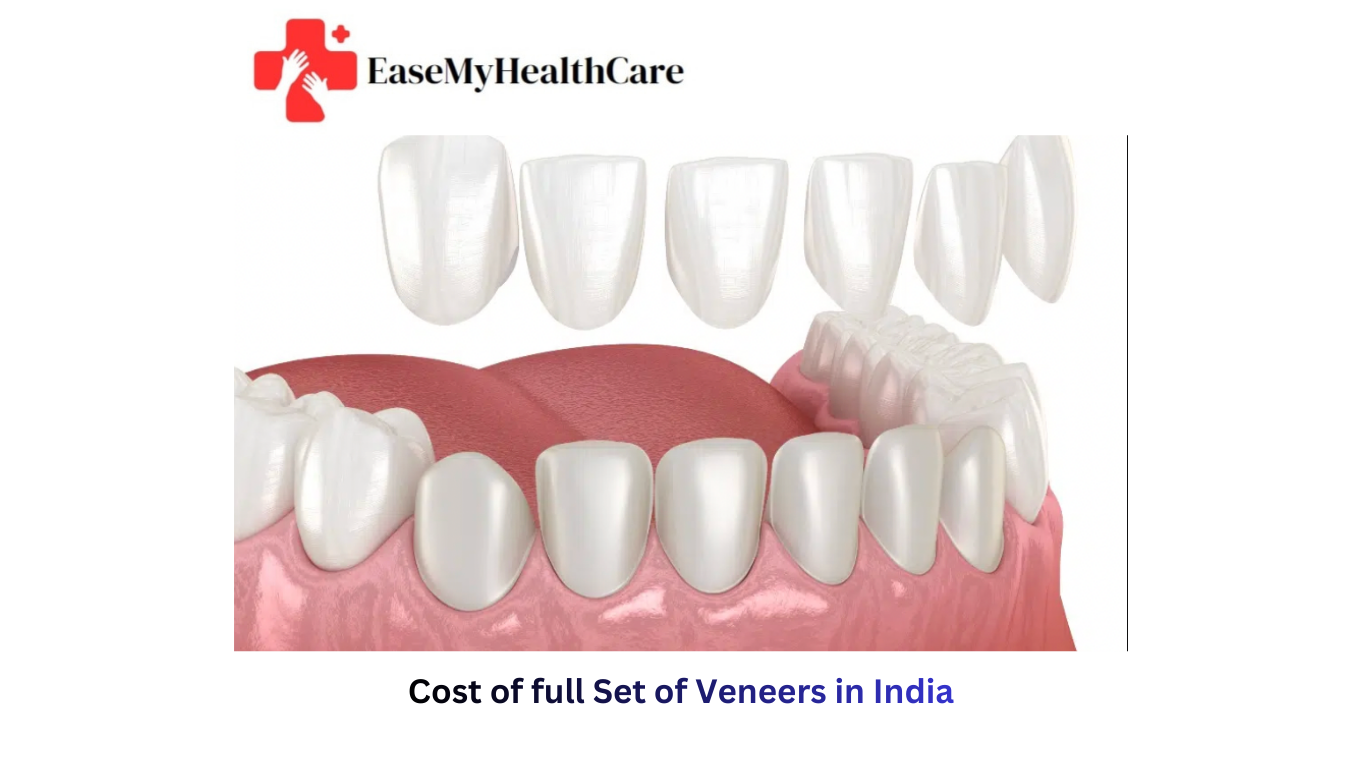 How Much Is a Full Set of Veneers in India