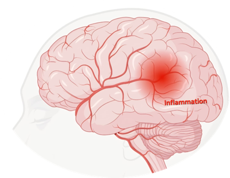 Best Meningitis treatment in India