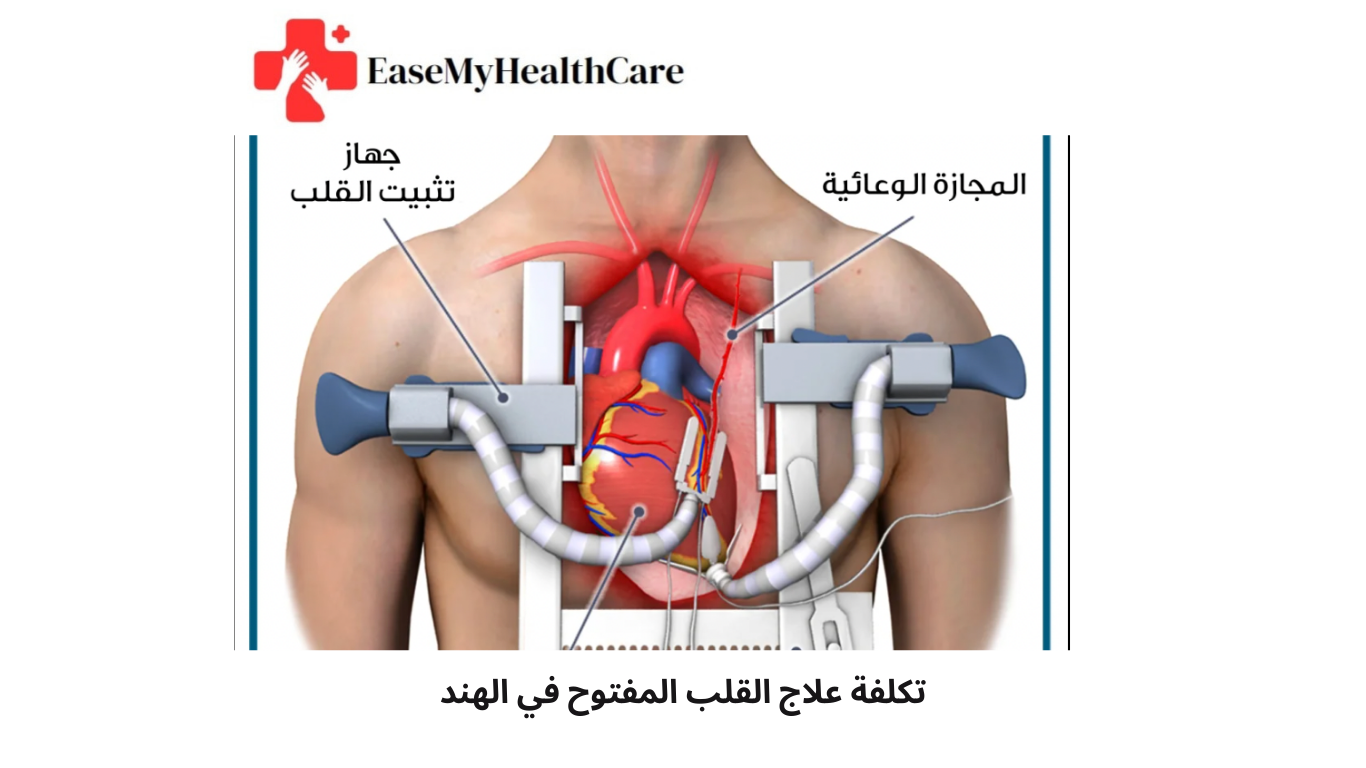 تكلفة علاج القلب المفتوح في الهند