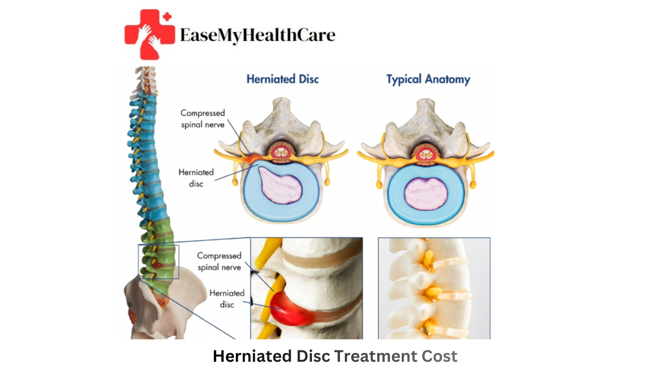 Herniated Disc Surgery in India