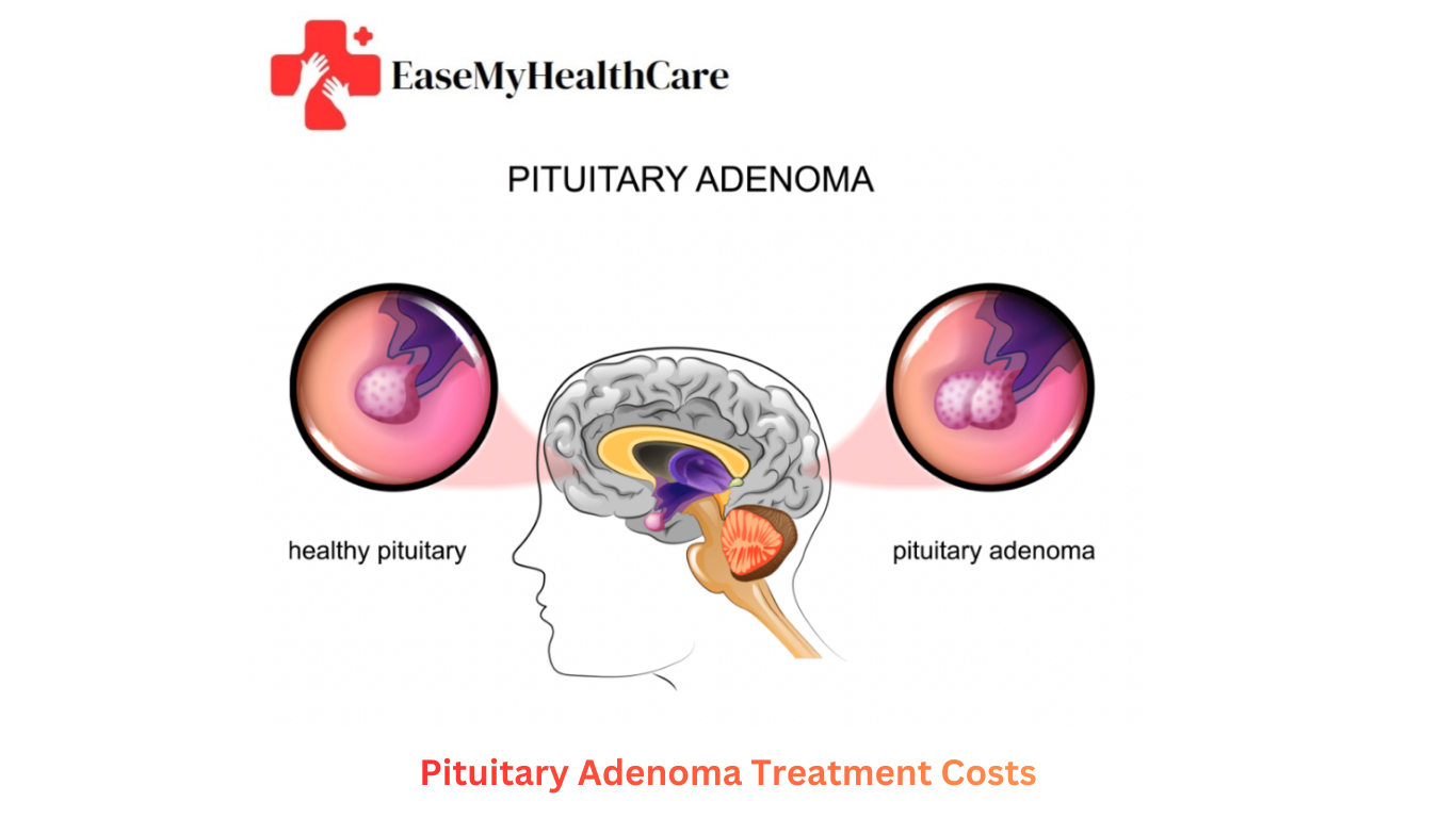 How Much Pituitary Adenoma Treatment Costs